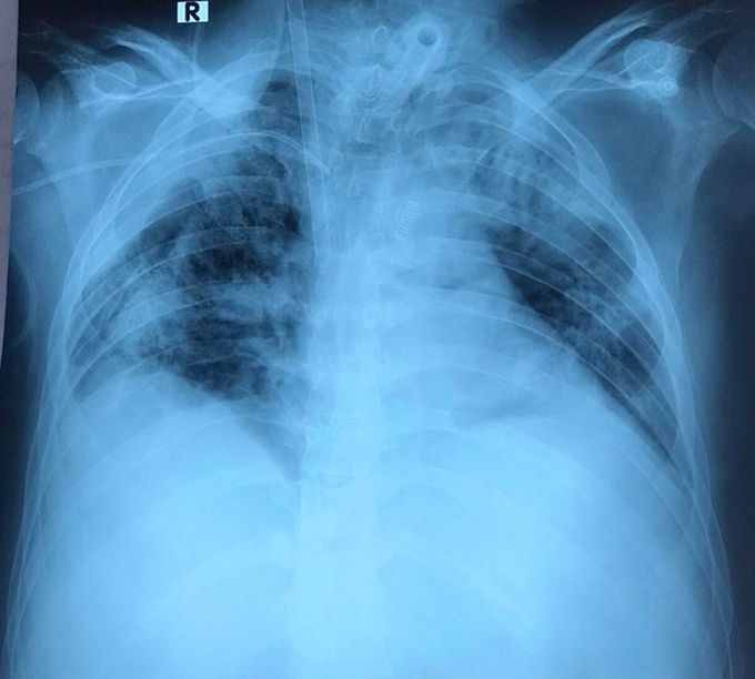 Bệnh nhân phi công được cho tập thở bằng phổi