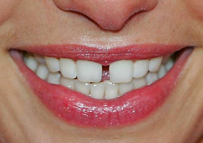 Tại sao kẽ răng hở khi dùng tăm thường xuyên?